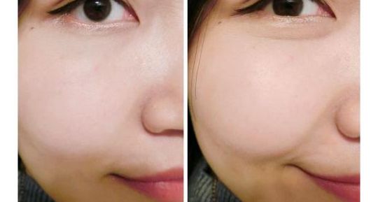 最佳專家推薦：成都五位頂級醫(yī)生精準(zhǔn)玻尿酸注射排行榜