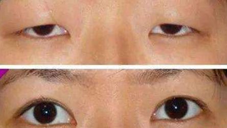 金華麗都整形為您呈現(xiàn)：雙眼皮神奇案例揭秘，專家力薦！