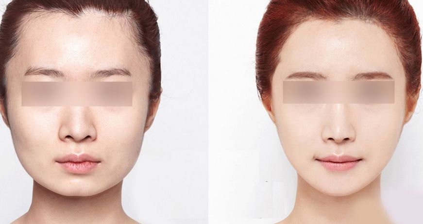 蚌埠三院美容科醫(yī)生推薦：疤痕修復(fù)案例分享與治療解析