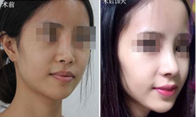 深圳哪家醫(yī)院隆胸效果好？排名前五火熱推薦！