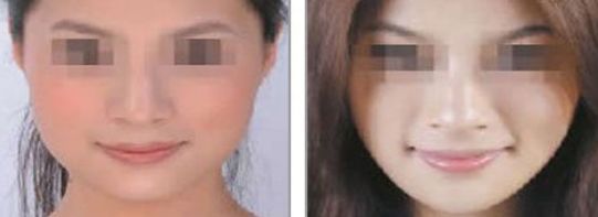 2024年適合自體豐胸的沈陽醫(yī)院有哪些好選擇？