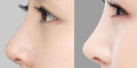 廣州隆胸修復有哪些值得信賴的醫(yī)院？豐滿胸部是否真的可行？