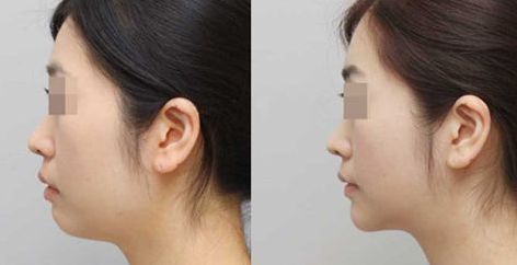 長(zhǎng)春哪家醫(yī)院治療肋骨鼻效果好，推薦這些知名醫(yī)院