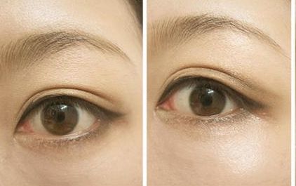 沈燕華醫(yī)生雙眼皮技術值得信賴，術后效果受到患者一致好評！