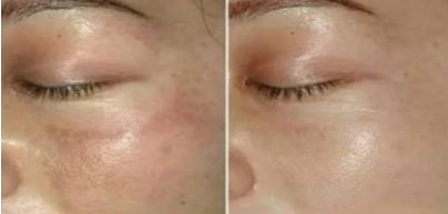 中國醫(yī)院雙眼皮修復(fù)技術(shù)，2023新晉熱門曝光！