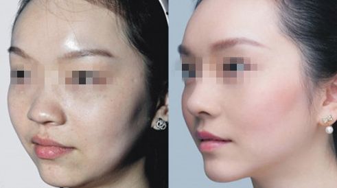 臺州哪家醫(yī)院治療乳頭矯正效果好？