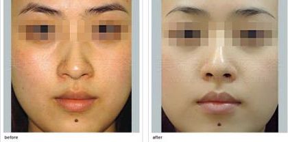 臺(tái)州狐臭治療中哪家醫(yī)院效果好？