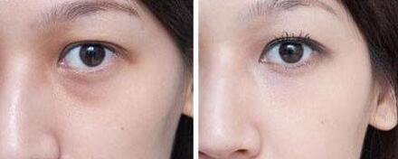 杭州藝星拉皮手術(shù)真的有效嗎？