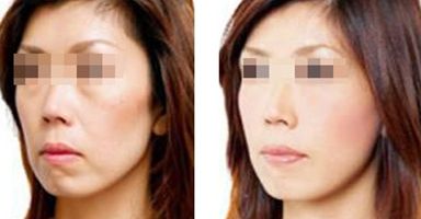 果酸祛痘間隔多久做一次？效果不明顯怎么辦？