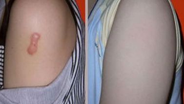 廣州天姿整形醫(yī)院，鼻部整形效果曝光，看看這次個(gè)案如何！