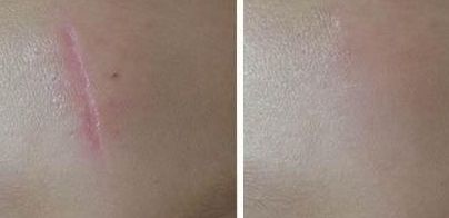 尋覓醫(yī)術出眾的武漢雙眼皮修復醫(yī)生，誰是不二之選？