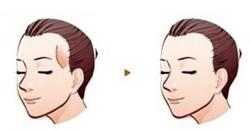 癌癥患者的雙眼皮手術費用分析及成功案例分享