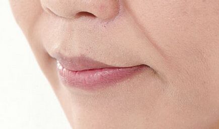 長沙愛思特整形醫(yī)院張嬌嬌修復案例及醫(yī)生簡介報告