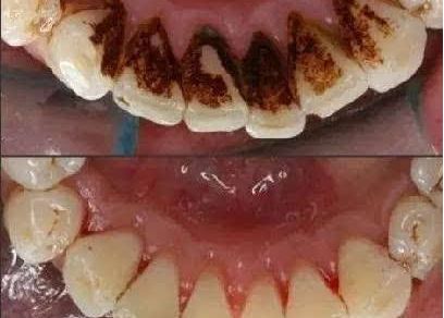 李雪陽(yáng)分享術(shù)后效果，想看雙眼皮圖片嗎？