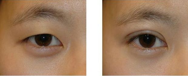 秦永平醫(yī)生雙眼皮手術(shù)效果如何？?jī)?yōu)美案例圖賞