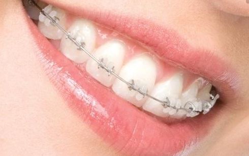 長沙瑞瀾李增產(chǎn)雙眼皮效果揭曉，2023最新案例揭露