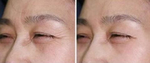 長(zhǎng)沙菲瀾整形醫(yī)院醫(yī)生名冊(cè)揭曉｜雙眼皮整形案例分享 + 價(jià)格一覽