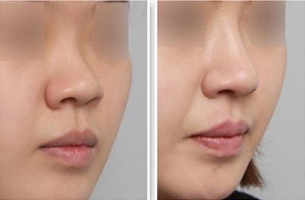 杭州最受歡迎的胸部整容整形醫(yī)院排行榜揭曉，網(wǎng)友推薦眾多醫(yī)院，有沒(méi)有熟悉的？