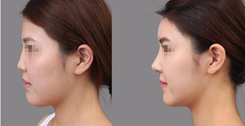 鄭州割雙眼皮醫(yī)院排名榜單揭曉，東方、華山等機(jī)構(gòu)躋身前十強(qiáng)！