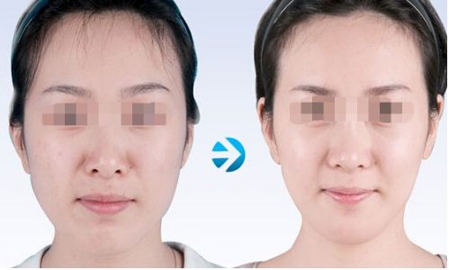 東莞締美蔣翔峰鼻整形口碑揭秘：技術水準與案例賞析