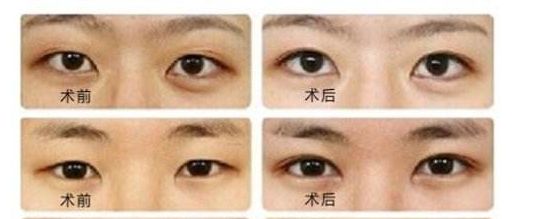 菲塑美減肥針：效果評估、價格和潛在風(fēng)險全解析