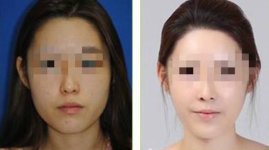 北京潤美玉之光脂肪填充測評：真實案例分享，效果與成活率分析