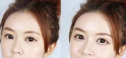 注射伊維蘭隆鼻，多久恢復消腫效果好？