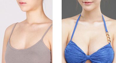 大連李爽矯治專家：隱形矯治、金屬托槽哪家好！