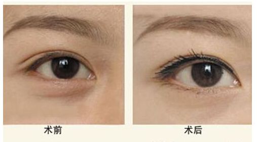 廣州墊下巴哪家醫(yī)院好？口碑技術(shù)分析及價格參考