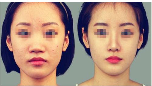 李保鍇鼻修復口碑調(diào)查 修復實例分享