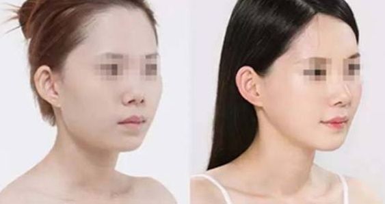 石家莊哪家整形醫(yī)院在隆鼻方面有口碑？