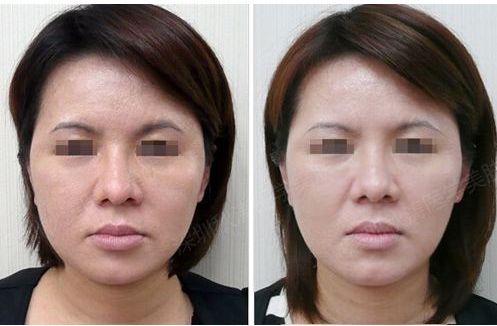 吉大一院皮膚科光子嫩膚效果怎么樣？專家團(tuán)隊(duì)解析祛斑案例