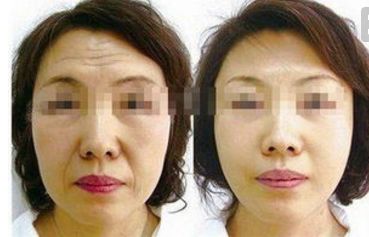 四川人民醫(yī)院王佳醫(yī)生提供下頜角整形案例，讓你輕松擁有小V臉