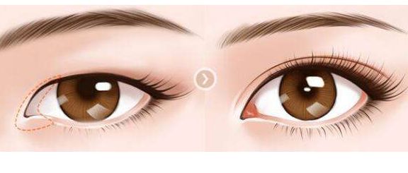 肖海濤的雙眼皮割成效如何？獨特技術吸引圈粉！