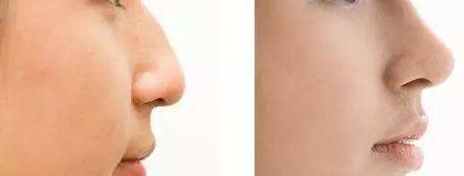 【2023】成都八大處田孝臣隆鼻案例揭秘，鼻部改善效果大躍進(jìn)！