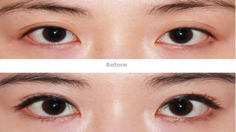 河南省中醫(yī)院整形科是吳盤紅、馬垟垟實(shí)力展示嗎？整形效果如何？