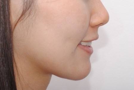 溫醫(yī)大附二院整形科鼻綜合修復(fù)效果可信賴嗎？徐海艇醫(yī)生的豐富經(jīng)驗(yàn)是否值得信賴呢？