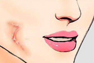 三亞心夢醫(yī)學劉濤醫(yī)生揭秘，無創(chuàng)吸脂實踐案例分享及收費解析！