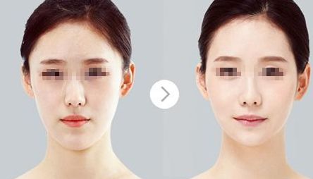 鄭州哪家醫(yī)院比較好做唇部整形？