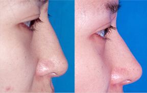 莆田黃金射頻微針去妊娠紋：2023年醫(yī)院排行榜全新公開(kāi)，這家醫(yī)院專業(yè)正規(guī)！