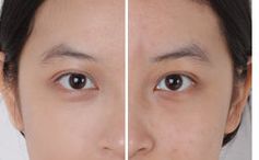 北京301醫(yī)院祛除眼袋方法揭秘，2023真實(shí)案例曝光！