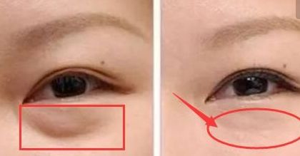 上海楊亞益雙眼皮修復(fù)技術(shù)解析，案例分享全文解讀