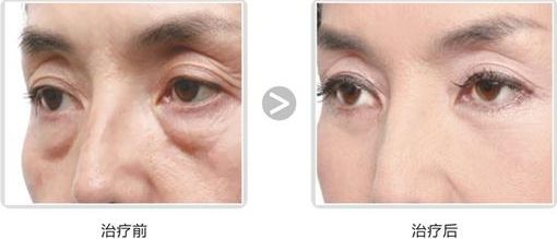 長沙哪家醫(yī)院做隆胸好？專家推薦！