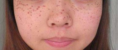 深度解析廣東萊美醫(yī)療美容醫(yī)院吸脂技術(shù)優(yōu)劣，費(fèi)用詳細(xì)解讀