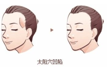 蘇州美貝爾與美萊：隆鼻比較！價(jià)格與特色對(duì)比！