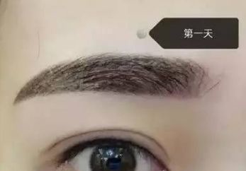 馮斌自體脂肪豐胸效果如何？案例分享給您