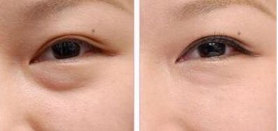 武漢愛思特整形醫(yī)院值得信賴嗎？專家團隊丨磨骨案例丨最新報價