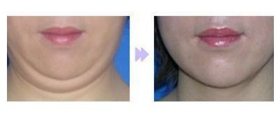 成都友誼醫(yī)院整形科優(yōu)秀醫(yī)師推薦：全臉脂肪填充效果如何？