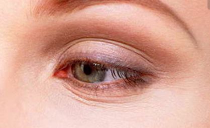 上海魏少奎醫(yī)生雙眼皮修復(fù)90天變化照片曝光