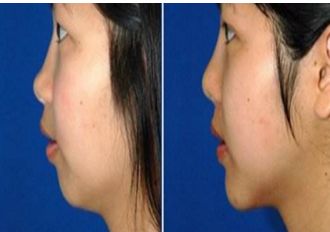 長(zhǎng)春銘醫(yī)整形注射哪位醫(yī)師技術(shù)精湛？專家推薦與費(fèi)用一覽